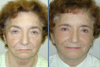 Patient will be haveing Blepharoplasty along with upper and lower eyelid lift. - Patient had droopy eyelids and eyebraws with excess skin of the upper and lower eyelids. She was very pleased with the natural and un-operated appearance after surgery.
