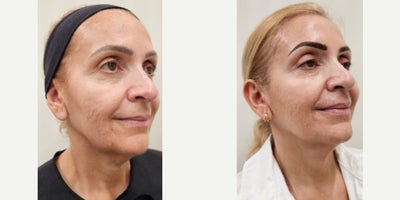 55-64 year old woman treated with Sylfirm X, Alastin Skincare, Ultherapy - Tailored Treatment Plan to treat skin sagging, specially on her neck, acne scars. Patient received Ultherapy session on jowls and upper neck. After 2 months, 2 sessions of our SylfirmX protocol on face and neck, combined with Benev Exosomes and Alastin Skincare. One month between the 1st and 2nd session. Pictures were taken just before her 3rd session.
