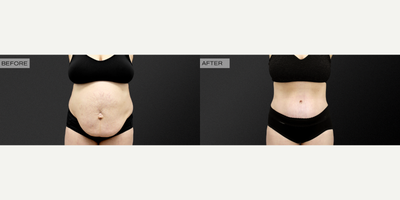 Standard abdominoplasty, rectus diastasis repair, and liposuction to bilateral flanks - This patient of mine is in her early 30's and is pictured here 3 months post-op from a standard abdominoplasty, rectus diastasis repair, and liposuction to bilateral flanks.