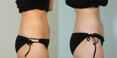 31 year old woman treated with Vanquish - 31 year old female treated with a  series of 4 treatments to abdomen. Picture was taken one month after the last treatment