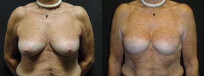 Implant-based breast reconstruction - 
	This 59-year-old woman with a history of breast cancer opted for immediate implant breast reconstruction with silicone gel implants. After photos at 1 year demonstrate excellent size and shape of her reconstructed breasts. She will be undergoing nipple-areolar complex reconstruction in the near future to complete her reconstruction.
