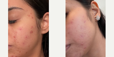 25-34 year old woman treated with Glycolic Peel - 1 week difference after 1 VI chemical peel. Redness and inflammation caused by acne was improved.