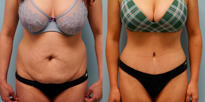 25-34 year old woman treated with Tummy Tuck - Full abdominoplasty with flank liposuction
