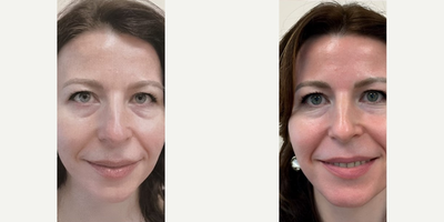 Woman treated with Sylfirm X - Stunning results after the third Sylfirm X Dual Wave RF Microneedling treatment! Skin is noticeably smoother and brighter, leaving a radiant glow.