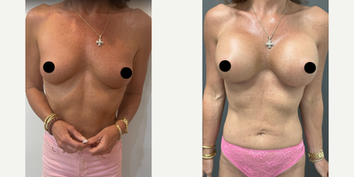 35-44 year old woman treated with Breast Augmentation - 35 year old woman treated with Breast Augmentation