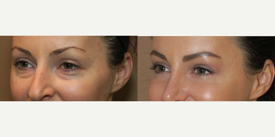 Woman treated with Eyelid Surgery - Woman treated with Eyelid Surgery