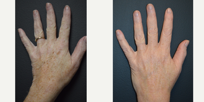 Single treatment using Cutera's Pico Genesis laser to treat brown spots on hands - This is a female in her 50s based in Stamford, CT who wanted to treat the brown spots or age spots on her hands. The results were taken about 3 weeks post treatment. The treatment only took about 15 minutes with minimal downtime and discomfort.