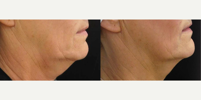 Woman treated with ULTRAcel - Woman treated with ULTRAcel