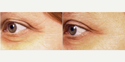 Woman treated with ULTRAcel - Woman treated with ULTRAcel