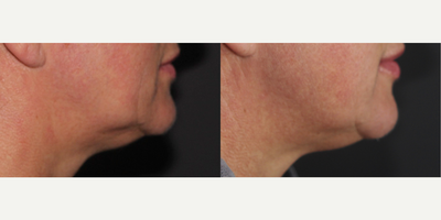 Woman treated with ULTRAcel - Woman treated with ULTRAcel