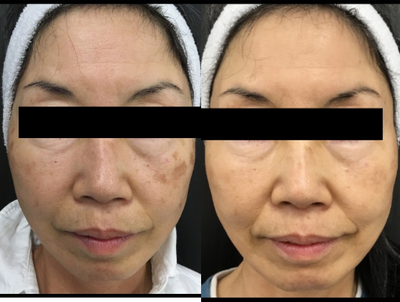 65-74 year old woman treated with Pico Genesis - Picogenesis to treat Melasma