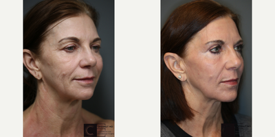 Silhouette Soft - Laser treatment with a lift.