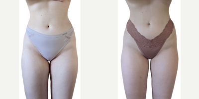 18-24 year old woman treated with CoolSculpting Elite - Patient wanted to reduce the amount of fat on her inner thighs. She received treatment on both thighs and we were able to help her achieve her desired result!