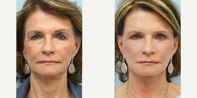 65-74 year old woman treated with Facelift, Eyelid lift, and Fat Grafting - She undergoes facial fat grafting, upper and lower blepharoplasty, revision face/necklift, and fractional CO2 laser skin resurfacing.  Post-op she still looks like herself but a much more rejuvenated facial appearance.