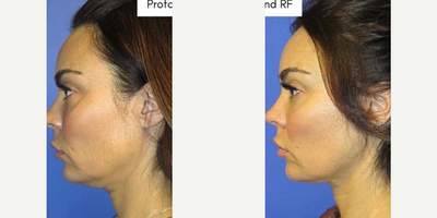 Woman treated with Profound RF - Woman treated with Profound RF