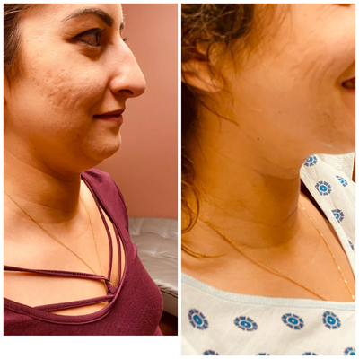 25-34 year old woman treated with Nonsurgical Facelift - Pt. treated with EVOKE, the only FDA approved hands-free platform available to remodel facial tissue and structurally reorganize tissue. Designed to deliver a more youthful appearance, EVOKE deploys proven bipolar radiofrequency energy to the cheeks, jowls, submental area, and jawline. The left hand photo of the split image is pretreatment. Notice the sagging jowl and neck. The right photo in the split is immediately post-treatment. The right-hand photo ids5 days post-treatment. Notice the markedly clearer skin and the sculpted jawline. No needles, no anesthesia needed.