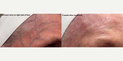 Woman treated with Sclerotherapy - Woman treated with Sclerotherapy.