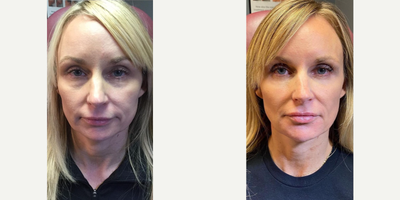 35-44 year old woman treated with Liquid Facelift, Dermal Fillers, Botox, Dysport - Over the course of one year, patient was treated with Dysport and dermal filler. Areas treated with filler include cheeks, undereyes, jawline, marionette lines, chin, mentalis crease, vertical lip lines, lip augmentation, and necklace lines. Patient received Dysport treatments every 3 months to the forehead, 11s, and crows feet.