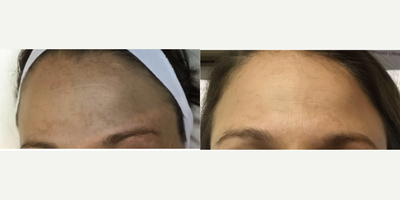25-34 year old woman treated with Vi Peel - Dream Spa Medical located in Brookline & Canton, MA.