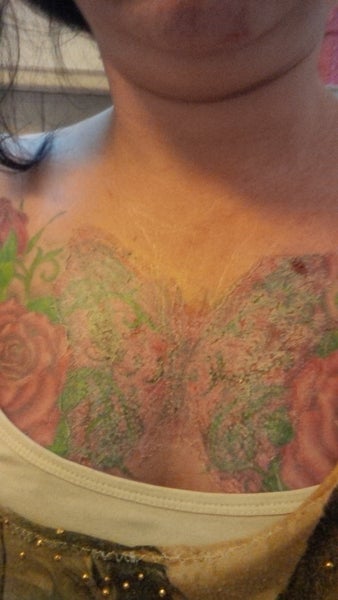 Tca Tattoo Removal Review Realself