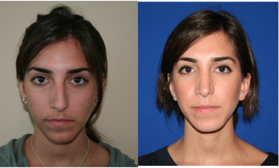 Rhinoplasty - 
	Rhinoplasty
