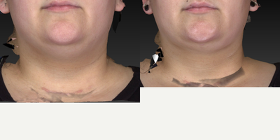 25-34 year old woman treated with Chin Liposuction - Chin and neck liposuction procedure to create a nice sculpted look around the area.