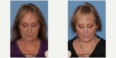 66 year old woman treated with Deep Plane Facelift, Neck Lift, Eyelid Surgery, CO2 Laser, MACS Facelift - 66 year old woman treated with Deep Plane Face and Neck Lift, Lower Blepharoplasty, CO2 Laser ofFace, MAC