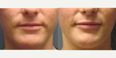 Lip Implants for this 29-year-old Woman - This 29-year-old female had lip augmentation with implants. She is 7 weeks recovered.