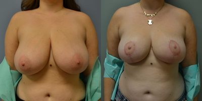 25 year old woman treated with Breast Reduction - 25 year old woman treated with Breast Reduction