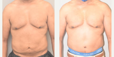 57 year old man treated with Male Tummy Tuck - 57 year old man treated with Male Tummy Tuck