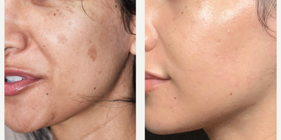 Los Angeles laser removal of age spots for Hispanic skin - When we say we can remove sun damage on any skin type, we mean it.  This is a young Hispanic patient with pretty profound sun spots and in one treatment, we cleared them all.  Our q-switched Palomar Q-Yag V laser is perfect for this treatment because we can blend two wavelengths to safely and effectively remove age spots in 1-2 treatments on darker skin.