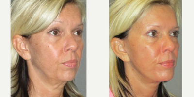 45-54 year old woman treated with Mini Lift - This young lady presented to our Center with early signs of jowling and loss of her jawline definition. In addition, she stated that her neck and area under her chin was starting to droop. We recommended and performed a mini lower facelift to re-establish her jawline and tighten the skin and muscles of the lower face and upper neck. This procedure was performed comfortably in our Center using only local anesthesia and mild oral sedation with valium. All of her sutures were removed in one week, and she was allowed at that time to resume normal activity.