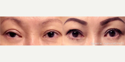 Woman treated with Double Eyelid Surgery - This patient traveled to Korea for her upper blepharoplasty a year ago, but her post-op was complicated by prolonged swelling and worsened ptosis on her right upper eyelid.A non-incisional ptosis repair was performed on her right eyelid to help correct the iatrogenic ptosis, which also helped lower the crease on the right eyelid concurrently. The second photo was taken just a week after surgery, with beautiful results.Non-incisional methods typically have a shorter recovery time, but can only be employed on selective candidates.