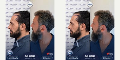 45-54 year old man treated with DHI Hair Transplant - A total of 4000 grafts were transplanted using the DHI technique.The implantation was focused on the frontal and mid-scalp areas, with approximately 2300 grafts placed in the frontal zone and the remaining grafts distributed across the mid-scalp for balanced density.