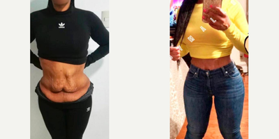 25-34 year old woman treated with Tummy Tuck, Liposuction, Brazilian Butt Lift - Excellent outcome after full tummy tuck combined with intense liposuction including abdomen, waist, laterals and upper and lower back to improve your body contour and get better curves, especially in your waist area and dominican butt lift.