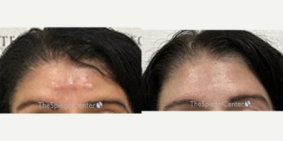 55-64 year old woman treated with Scar Removal - 55-64 year old woman treated with Scar Removal