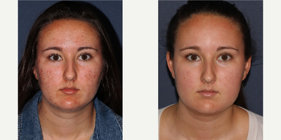 18-24 year old woman treated with Photodynamic Therapy - PDT is used to treat acne in a young female patient.