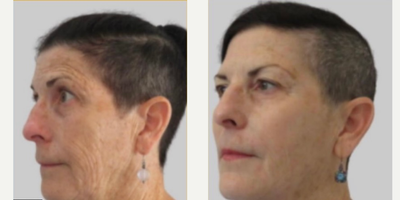 65-74 year old woman treated with Vampire Facelift, Sculptra, Restylane Defyne, ReFirme, Botox - Patient receiving a number of treatment services, here at About Face Centers.