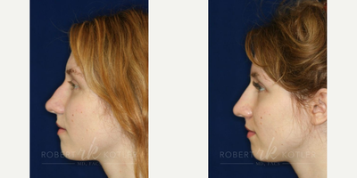 Permanent Non-surgical Rhinoplasty - Obscuring hump. Improving tip structure. Perfecting the bridge.