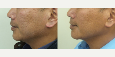 55-64 year old man treated with Vivace - This patient had a series of 3 Vivace full facetreatments to resolve acne scarring.