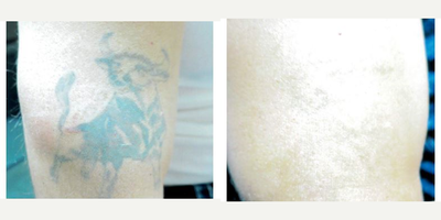 Tattoo Removal - 5 treatments with the Enlightened tattoo removal machine.