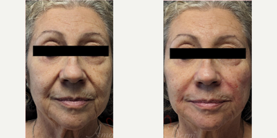 65-74 year old woman treated with Juvederm, Restylane, Vollure - Treatment of nasolabial folds (laugh lines) and marionette lines with Juvederm, Radiesse, Vollure, Restylane or Bellafill injected with cannula