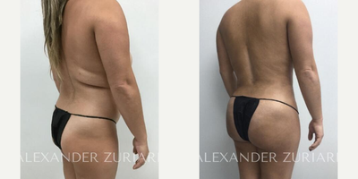 25-34 year old woman treated with Brazilian Butt Lift, Liposuction - 25-34 year old woman treated with Brazilian Butt Lift, Liposuction- 3 weeks post-op