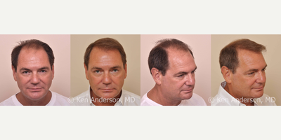 57yo man -  ARTAS Robotic Hair Transplant, and PRP with ACell - Norwood 5-6 Age: 57	 Clinical History: He had been experiencing hair loss for years, and decided to take action in January of 2015. Patient told me that his hair loss made him look and feel oldolder than he wanted to look and feel. He said that he watched a video of himself giving a presentation at a conference, and was surprised to see how little hair it appeared he had when on camera. He says he researched hair restoration surgeons for about 8 months online. We had a virtual consultation over the phone, along with an online slide show that we both went through as I explained to him some of the subtleties and nuances of a robotic hair restoration procedure. We spent an hour on the phone with patient in January of 2015, and he had his ARTAS with PRP and ACell procedure with us in June of 2015. Clinical Decision Making: Patient was realistic about his hair restoration goals. He wanted a bit more hair on top and in the front to improve his looks. He was aware that he did not have enough donor hair to restore his scalp to a full head of hair, and was not concerned about the crown area in the back. We spent time discussing preventive therapy, including Propecia, Rogaine, platelet-rich plasma with ACell (PRP with ACell) therapy, as well as low level laser therapy (LLLT). He stated he was not interested in doing any preventive therapy. Patient elected to proceed with an FUE procedure with me, using the ARTAS Robotic Hair Transplant System. We reviewed the need to trim his hair for the procedure, as well what would be accomplished on the pre-operative day, as well as how his surgery day would go. He was given pre-operative instructions and all of his questions were answered in full. Surgical Intervention: Patient had one single ARTAS Robotic Hair Transplant Procedure in June of 2015, performed by Dr. Ken Anderson, MD. We completed his hair restoration with 1,831 grafts placed in the following areas: central bridge, frontal forelock, frontal hairline, and bilateral temporal recessions. In addition to the ARTAS procedure, just like every surgical patient at the Anderson Center for Hair, he also had a platelet-rich plasma (PRP) with ACell treatment, as well as micro-needling to a depth of 1mm in the recipient area using some of his platelet-poor plasma (PPP) at the time of procedure. The remainder of his PPP was used on the implanted grafts following the procedure. I feel the benefits of a platelet-rich plasma (PRP) with ACell treatment in conjunction with a hair restoration procedure are so positive for the wound healing that I dont operate without using PRP unless a patient specifically declines. Results: These pictures were taken 11 months following his ARTAS FUE procedure in May of 2016.&nbsp;
