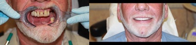 All-on-4 Dental Implants Las Vegas - The All-on-4 is the modern solution for all missing teeth. This treatment concept replaces your missing teeth with a Full Dental Bridge, No Palate, No Excess Material, Not Removable, and supported by only Four Specialty Dental Implants, with two of the Implants placed at precise angles. With less implants needed, overall treatment time is reduced. The unique All-on-4 solution also ensures greater stability in the bone, reducing the need for bone graft surgery to increase bone volume. Your teeth will look, feel and are brushed much like natural teeth, and you can lead a normal life immediately after a 1 Day surgery. Studies indicate that Patients receive 90-95% chewing ability.&nbsp;