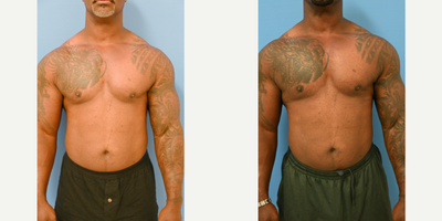 45-54 year old man treated with Pec Implants - 48 year old male body builder from Florida only one week after pectoral implants performed by Dr Sam Gershenbaum. This gentleman's interest was to add more volume and shape to the midline and upper chest. A vertical rectangular soft solid silicone implant was placed under the muscle up high and medial. He will develop more definition centrally as the healing process progresses. He looks natural as requested and has certainly achieved his goals.