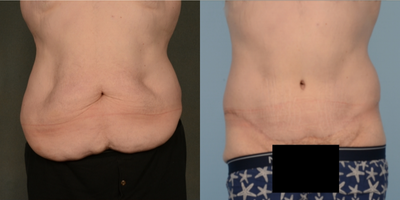 45-54 year old man treated with Tummy Tuck - 4483 grams removed. Massive Weight Loss