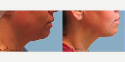 Woman treated with AccuTite - Woman treated with AccuTite