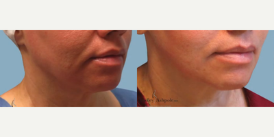 Woman treated with AccuTite - Woman treated with AccuTite