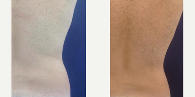 35-44 year old man treated with Vanquish - Combined treatment of technologies to reduce measurements in the waist area.